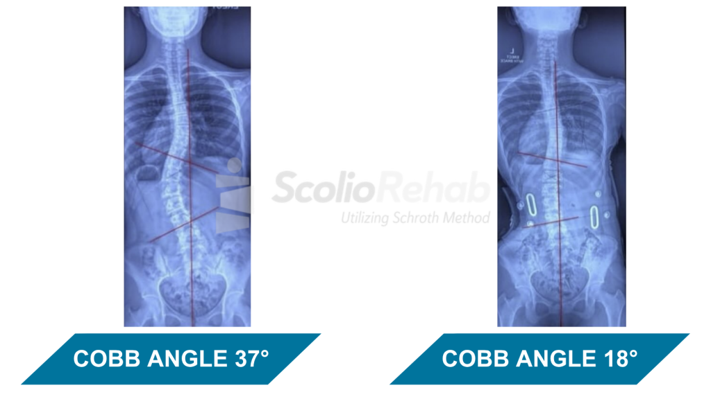 Cobb Angle Reduce Testimonial ScolioRehab