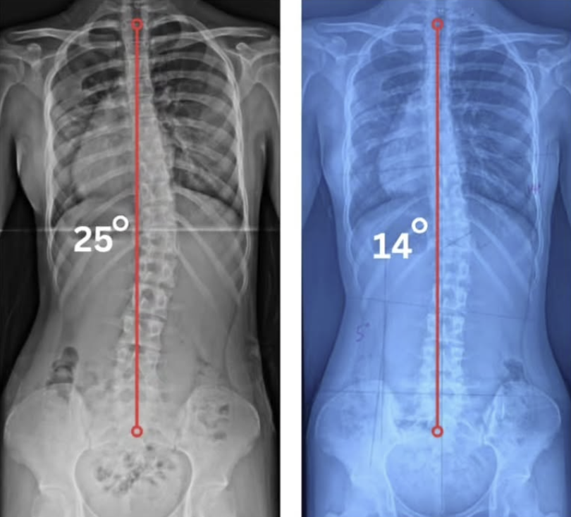 Patient result 25 degree to 14 degree
