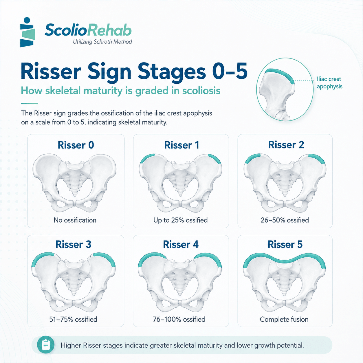 risser sign stage explained